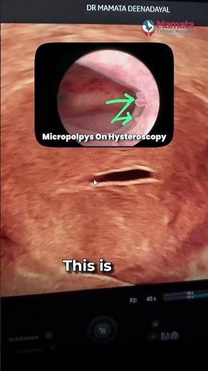 Endometrial Micropolyps on Ultrasound | Mamata Fertility Hospital: Hyderabad