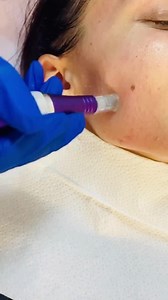 DERMAPEN BABY FACE LASER LUMINA ROȘIE ✔️ Beneficii : stimulează colagenul , tratează semnele cauzate de acnee , porii dilatați , excesul de seboree Preț :200€ Programări :0722296007 | Clinica Beauty Art Aesthetics