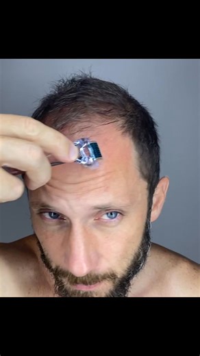 2.9K views | How to Use DermaRoller for Hair Loss Treatment Baldness Derma Roler  https://geni.us/derma_roller | Fernando Wi | Facebook