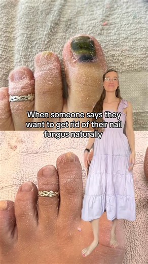 DIY Nail Kits Here: https://www.livholisticstore.com/product/diy-nail-fungus-set-10ml-oils-/72 After I couldn’t take the antifungal pills for my nail fungus (the side effects were so bad🤮), a friend recommended trying tea tree and oregano oil. At the time, I didnt use essential oils at all so I just thought “whatever, I’ll try anything.” … So to my surprise, it actually worked. I shared about it working on social media a few years ago and lots of comments were asking for DIY kits with exactly w