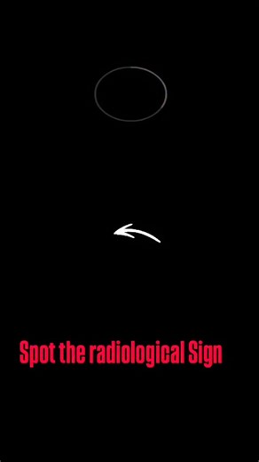 Radiology Made Easy Notes by Dr Navni Garg on Instagram: "Radiological Signs 17: Twin Peak (Lambda) Sign Case shared by Dr Shubhi Agarwal 👶 Early pregnancy ultrasound showing Lambda (Twin Peak) sign 🔹 Triangular echogenic projection of chorion between the two gestational sacs 🔹 Seen at the placental–intertwin membrane junction 🔹 Suggestive of Dichorionic Diamniotic (DCDA) twin pregnancy ✨ Why it matters? ✔ Confirms chronicity in first trimester ✔ DCDA twins → lower risk of twin-to-twin trans