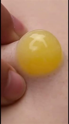 The pimple… just exploded!! 💥