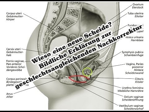Tag 0: Wieso eine neue Scheide? Bildliche Erklärung zur geschlechtsangleichenden Nachkorrektur