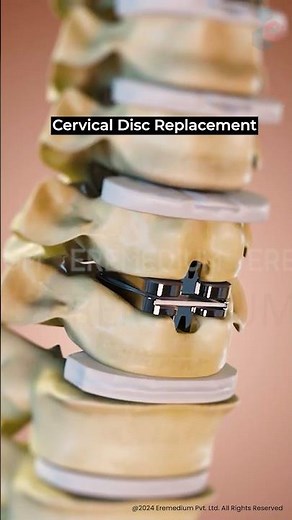 Cervical Disc Replacement Surgery ↪ 3D Medical Animation #Shorts #DiscReplacement #Surgery