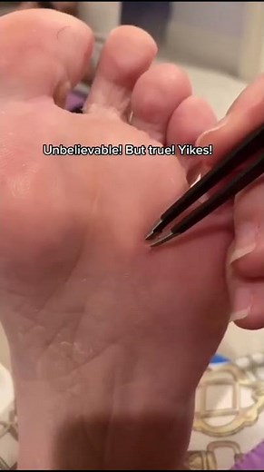 Removing big splinter from foot