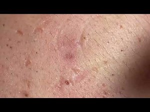 Acne Treatment Huong Da Nang# _ 2024 #blackheads 703