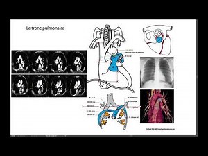 11a Pulmonary arteries