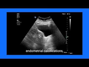 Uterine dystrophic Calcifications: Causes, ultrasound Diagnosis, and Management in Elderly Women