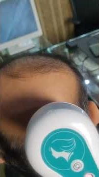 Visible improvement in scalp density and hair volume By Dr. Ahmad Chaudhry