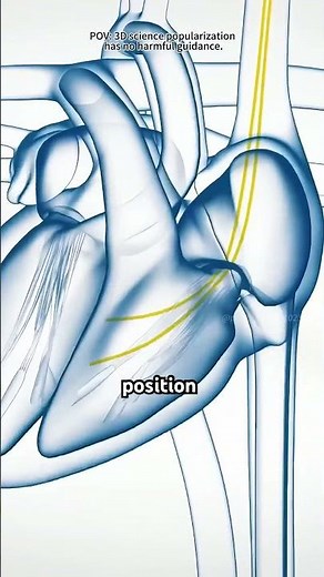 How Pacemaker Insertion is done (3D Animation)