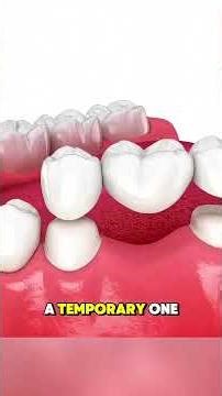 How Dental Bridges REALLY Work 🦷✨! #facts #knowledge #interestingfacts #interesting #shorts