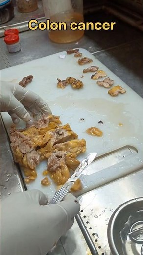 Colon carcinoma specimen grossing| #histopathology #coloncancer #coloncancerprevention #colonoscopy