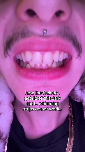 I think its just damaged permanently from erosion due to having my vertical labret pierced for years