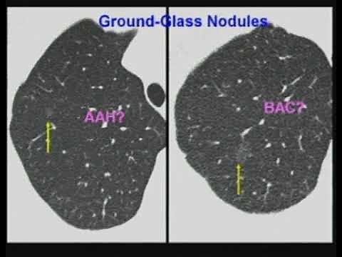 Pulmonary Nodules Imaging Analysis and Management