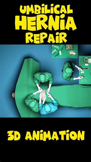 Umbilical Hernia Repair Surgery: Effective Treatment Procedure