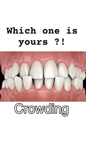 Crowding, Braces , occlusions #orthodontist