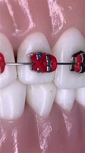 🔥Formas y Figuras con Módulos Elásticos Rojos 🔴en los Brackets 😬🔥