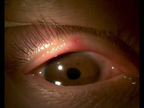 Meibomian obstruction soft squeezing changine to clear oil