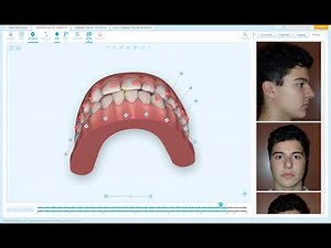 Quick Tip - Bite Correction Visualization in Aligners
