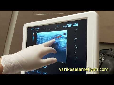 Recurrent Varicocele Examination and Preparations for Surgery