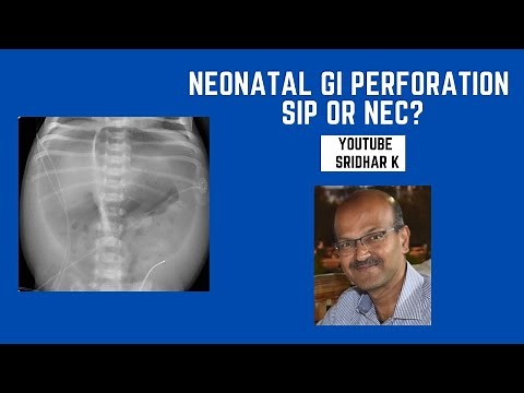 SIP or NEC? Neonatal pneumoperitoneum l gut perforation #SIP #NEC