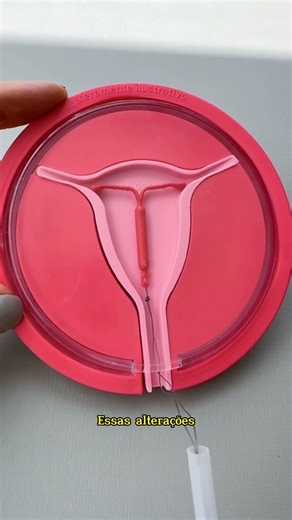 How does the hormonal IUD work?