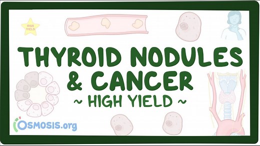 Thyroid nodules and thyroid cancer: Pathology review: Video, Causes, & Meaning | Osmosis