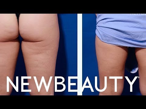Noninvasive Body Contouring with Velashape | Between The Before & After Ep. 4 | NewBeauty