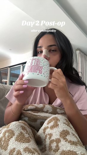 Rhinoplasty Day 2 Post-Op: Swelling, Bruising & Recovery Tips