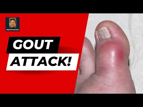 Gout Tophi Squeeze