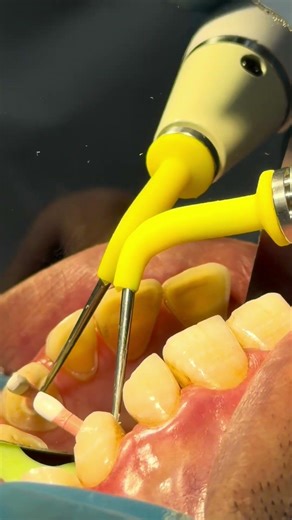 Precision Endodontics | Gutta-Percha Trim