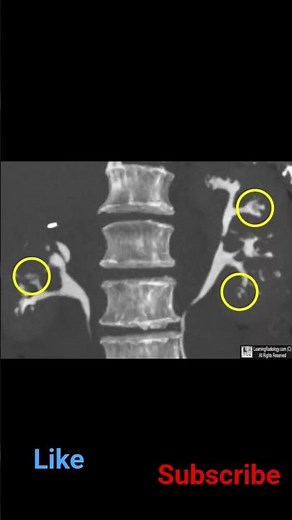 causes of papillary necrosis in kidney