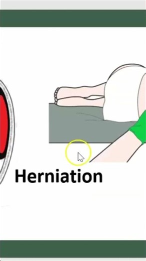 Lumbar Puncture: Risks of Herniation You Should Know #shorts