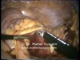 Laparoscopic Right Extended Colectomy • Video • MEDtube.net