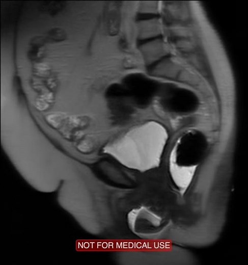 Grade 1 Cystocele Grade 3 Vaginal Prolapse Grade 1 Rectocele