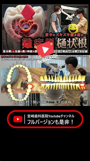 【夜中にズキズキ歯が痛む】昔治した虫歯の奥で進む重度感染…難症例「樋状根」の全記録 #宮崎歯科医院