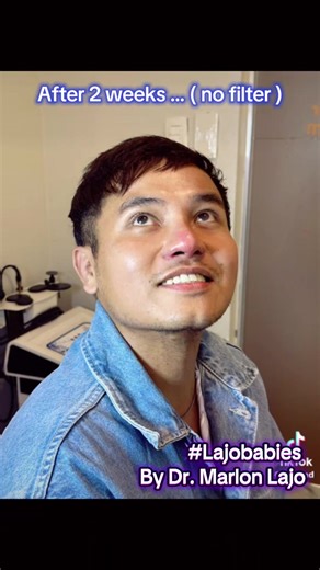 2nd week: self upgrade #Lajobabies #marlonlajo #docmarlonlajo #rhinoplasty ear cartilage w/ ePTFE