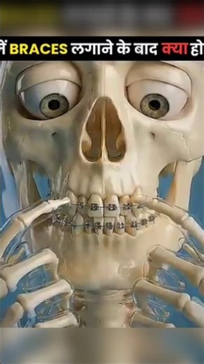 दांतों में brance लगवाने के बाद क्या होता हैं 🤔 #shorts #factoholic #facteduvation
