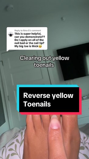 Natural Nail Fungus Treatment Tips for Healthy Toenails