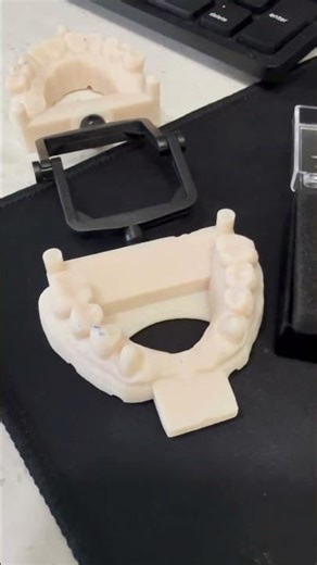 Replacing 4 Missing Front Teeth: 6-Unit Bridge #dentalbridge #dentist