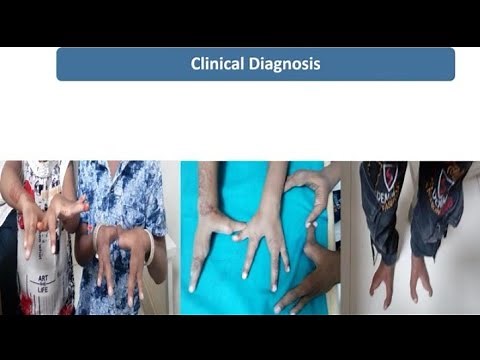 Split Hand and Foot Syndrome (SHFS) or Lobster Hands || Spot Diagnosis - 3 || Pediatrics