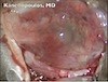 Gunderson Flap in Severe External Disease - Eyetube
