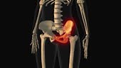 A medical animation of hip bone pain would visually represent the...