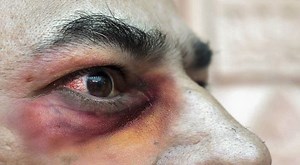 Mucormicosis en pacientes COVID-19: 5 datos claves sobre el mortal hongo negro