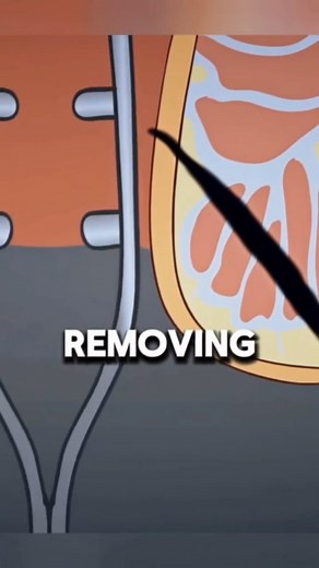 1.3K views · 16 reactions | Watch how advanced laser surgery treats...