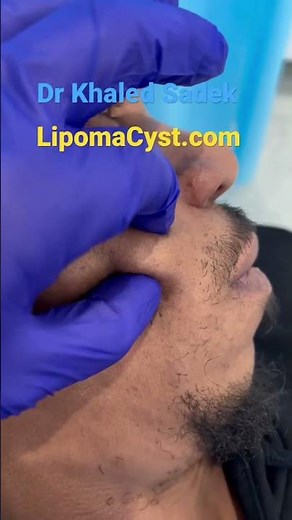 Multiple face cyst #skincare #blackheadremoval Dr Khaled Sadek LIPOMACYST clinic