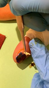 5.7K views · 32 reactions | Woman has to have baby insect removed...