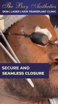 Bay Aesthetic’s Precision Suturing | The Art of Flawless Healing