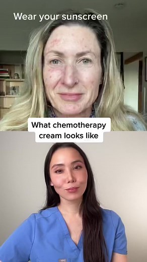 Topical Chemo Cream for Skin Cancer Prevention and Treatment