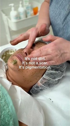 What Causes Skin Pigmentation? #Pigmentation